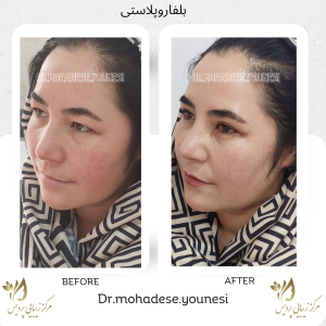 بلفاروپلاستی بعد از ده روز