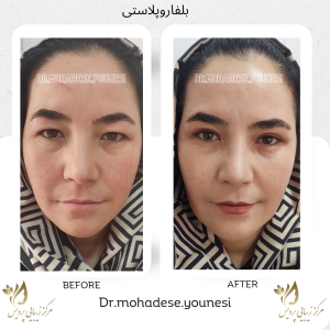 بلفاروپلاستی پس از 10 روز