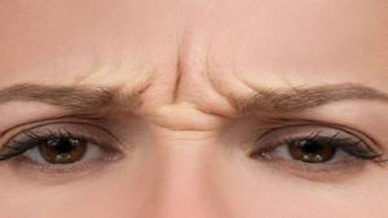 بوتاکس برای خط اخم
