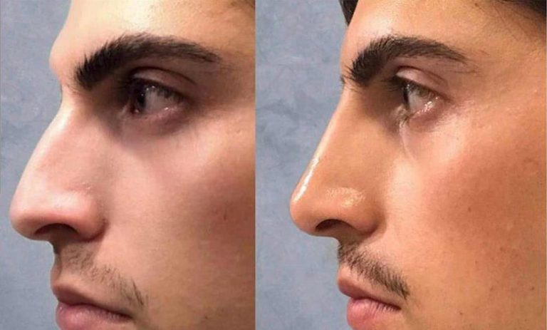 تزریق فیلر بینی