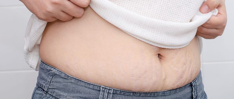 کربوکسی تراپی استرچ مارک