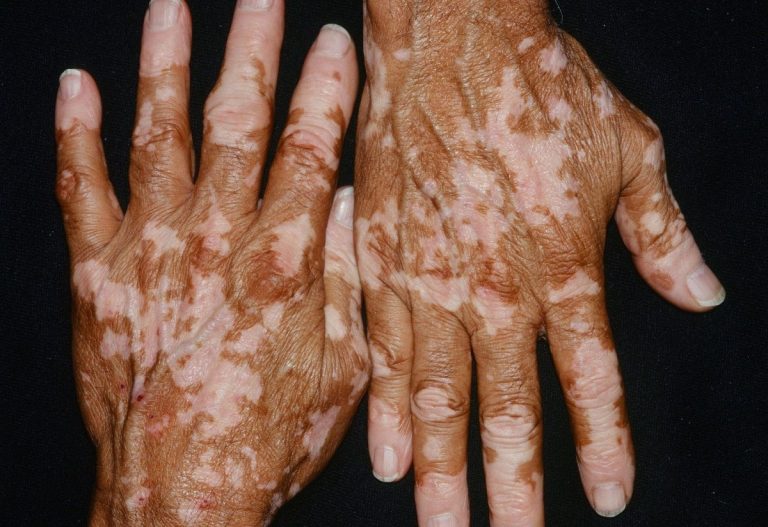 12491520220208 vitiligo skin