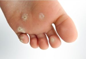 علائم میخچه