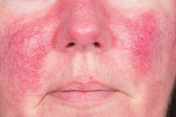 بیماری روزاسه