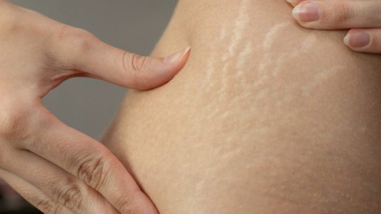 استرچ مارک یا ترک پوستی