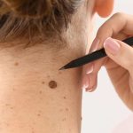 mole